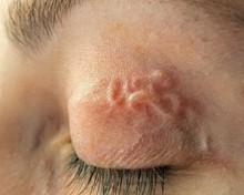 Комары заражают подкожными червями украинцев