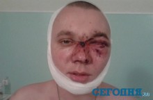 В клубе на Днепропетровщине 7 охранников до полусмерти избили и лишили глаза посетителя (ФОТО)