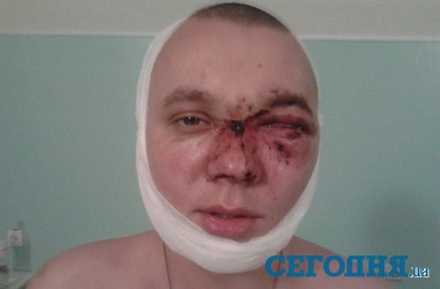 В клубе на Днепропетровщине 7 охранников до полусмерти избили и лишили глаза посетителя (ФОТО)