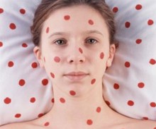 За последние два года уровень заболеваемости корью в Украине вырос в 80 раз