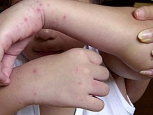 В Красноармейске вспышка энтеровирусной инфекции