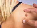 melanoma_rodinka