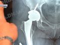 У Покровській КЛІЛ проводять унікальні операції з ендопротезування