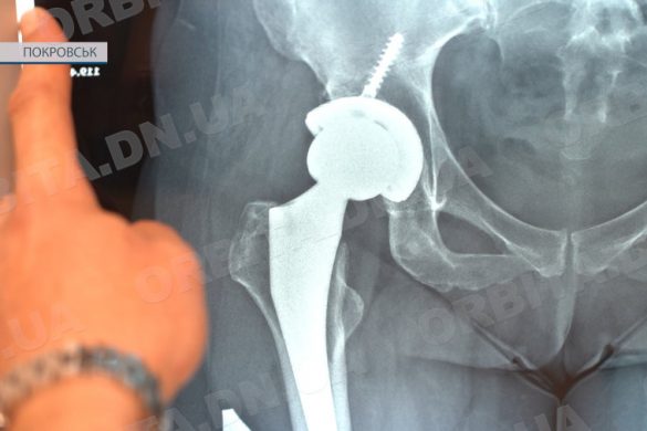 У Покровській КЛІЛ проводять унікальні операції з ендопротезування