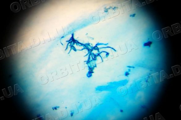 Всесвітній день боротьби з туберкульозом: краще бути обережним, аніж витрачати життя на лікування