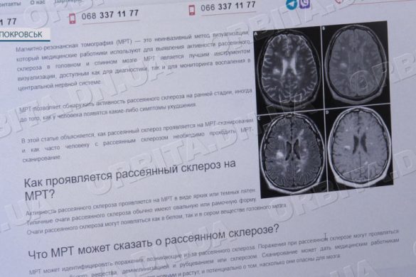 Чим небезпечний розсіяний склероз та як його уникнути