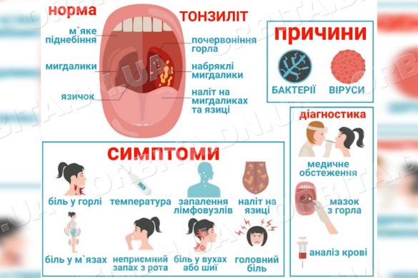 Підступний мікроб. Як побороти хронічний тонзиліт